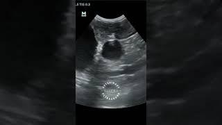 Gallbladder and dilated duct followed up to the duodenal papilla