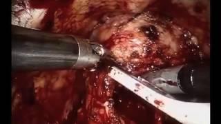 Prostate Surgery by Dr. Amit Ghose