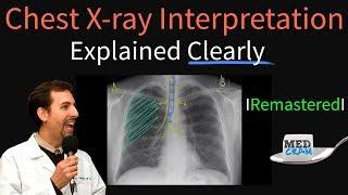 Chest X Ray Interpretation Explained Clearly - How to read a chest Xray