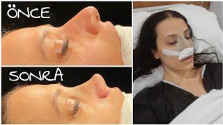 Kapalı Burun Estetiği  ( Rhinoplasty ) - TÜM SÜREÇ  - CANLI BANDAJ ÇIKARTMA - BU NEE ÖDEMM !!