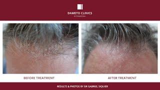 Cellbooster® Hair - Dameto Clinics International