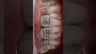 Dental motivation. Preparation teeth. Ceramic veneers. #dentistry #dental #veneers #dentaltreatment