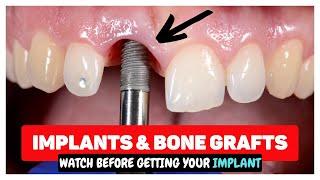 Dental Implants & Bone Grafting after Tooth Extractions