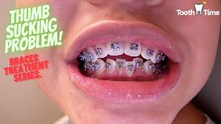 Braces on - Thumb sucking problem treatment - Video #1 - Tooth Time Family Dentistry New Braunfels