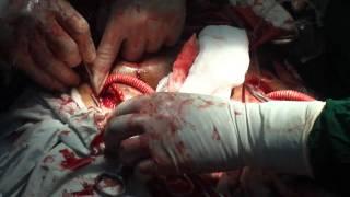 Aorto Bi-femoral Grafting.wmv