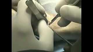 Prosthetic Arthroplasty of the Thumb CMC Joint - Dr. Alejandro Badia - Hand Surgeon