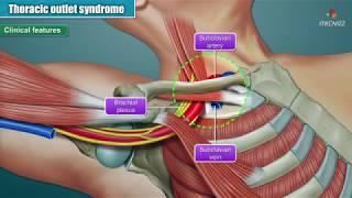 Thoracic outlet syndrome ( Part-2 ) Animation : Clinical Features ,  Diagnosis and Treatment