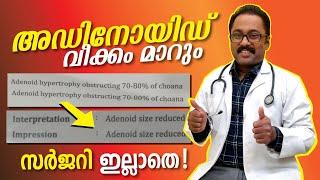 അഡിനോയിഡ് വീക്കം പൂർണമായി മാറാൻ adenoid treatment without surgery #adenoids #malayalam #healthtips