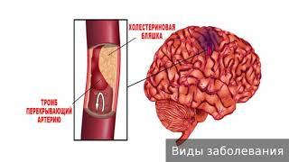 Инфаркт мозга. Как лечить инфаркт мозга.