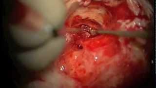 Eustachian Tube Closure in Chronic Ear Infection_Dr Nirmal Patel