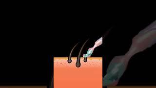This is how laser hair reduction works #facialenhancement #skincare #facial #drriteshaesthetics
