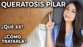 Keratosis Pilaris l What is it and how to treat it?