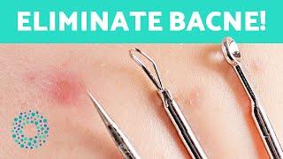 How to GET RID of SPOTS on Your BACK  (Eliminate BACNE)