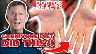 Man On Carnivore Diet LEAKS CHOLESTEROL! - Doctor Reacts