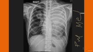 EXCELLENT CLASS ON MEDIASTINUM AND PLEURA BY A GREAT RADIOLOGIST SIR IBTESAM ZAFAR