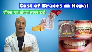 Cost of Braces and Aligners in Nepal / Dr Bikash Vlog