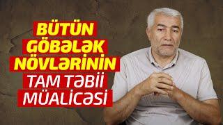 Bütün göbələk növlərinin tam təbii müalicəsi | Fizuli Hüseynov