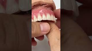 Removable denture!