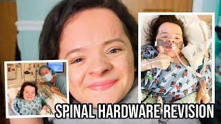 Successful Spinal Fusion Revision Surgery for Severe Scoliosis Patient