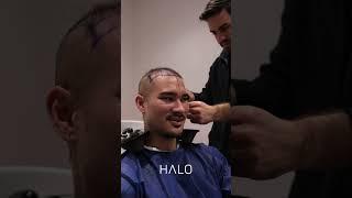 Hair Transplant by John Tran at the Halo Hair Clinic