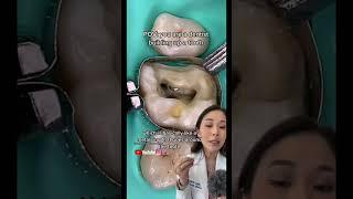 Building a tooth back up after cavity removal. #cavity  #dentistry #filling