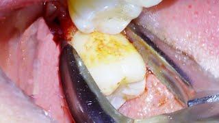 Dentist Easily Extracts Wisdom Teeth on Erupted 3rd Molars!