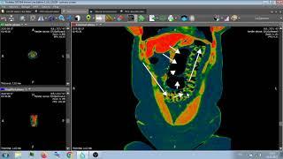 АНАЛИЗ ДВУХ КТ БРЮШНОЙ ПОЛОСТИ .
