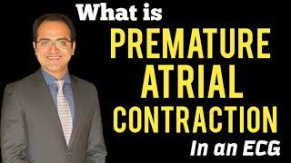 Premature Atrial Contraction/Complex (PAC) ECG Interpretation Atrial Rhythms, Treatment, USMLE