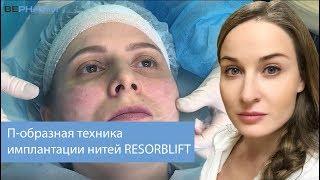 П-образная лифтинговая техника имплантации армирующих нитей RESORBLIFT