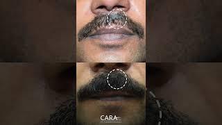 Moustache Hair Transplant Results at CARA #beforeafter #moustache