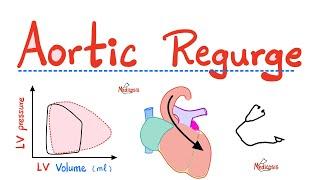 Aortic Regurgitation (AR) - Aortic Insufficiency - Valvular Heart Disease (VHD) - Cardiology