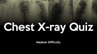 Chest X-ray Quiz: Medium Difficulty