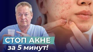 ПРЫЩИ УЙДУТ НАВСЕГДА за 5 минут! Как вылечить акне и наслаждаться жизнью