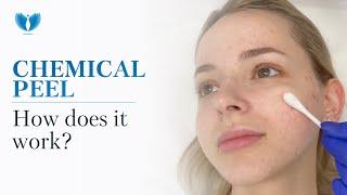 Chemical Peel - Chemical Peeling Treatment | Acne Solution | Chemical Peel for Acne and Acne Scars