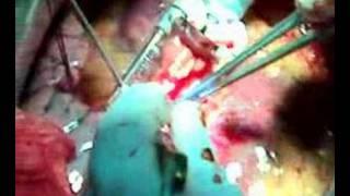 Beating heart CABG
