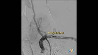 Live thyroid goiter embolization treatment