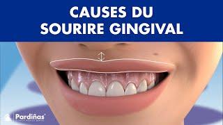 Causes du SOURIRE GINGIVAL - Montrez-vous beaucoup de GENCIVES lorsque vous SOURIEZ ? ©