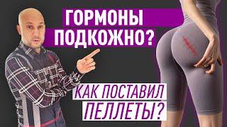 Гормоны под кожу? Как я поставил себе биоидентичные пеллеты?