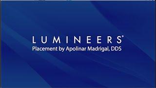 Time-Lapse Lumineers Placement by Apolinar Madrigal DDS | denmat.com | DenMat Dental Education