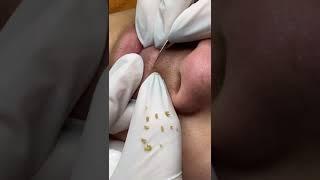 Limpieza Facial - Extracción de Granos