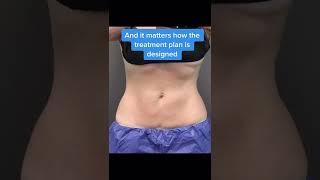 CoolSculpting Results: Before & After | Greer Plastic Surgery