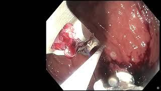 Endoscopic Sleeve Gastroplasty (ESG): 3 minute narrated procedure