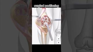 (knee replacement )surgery view for better understanding