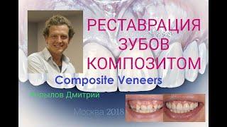 Композитные виниры.  Трансформация клыков в резцы. Виниры до и после. Composite veneers.