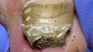 Thick nails, hidden surprises underneath, thick black mud【Doctor Liu Pedicure】
