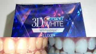 Guy with yellow teeth tests out whitening strips for 20 days (Crest 3D Whitestrips)