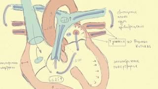 Дефект межжелудочковой перегородки. Врожденные пороки сердца.
