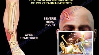 General Trauma ,Management of Polytrauma Patients - Everything You Need To Know - Dr. Nabil Ebraheim