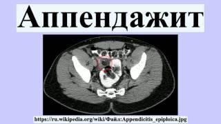 Аппендажит