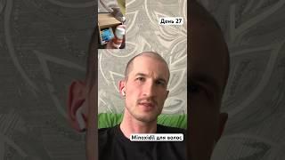 Minoxidil для волос. #minoxidil